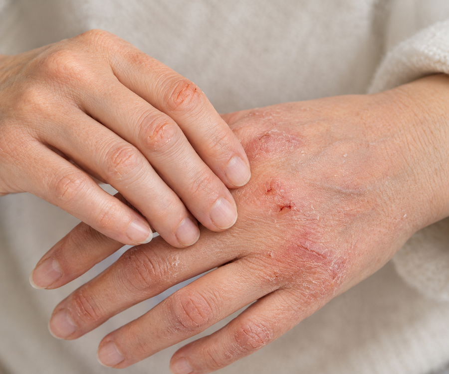 Les mains abîmées